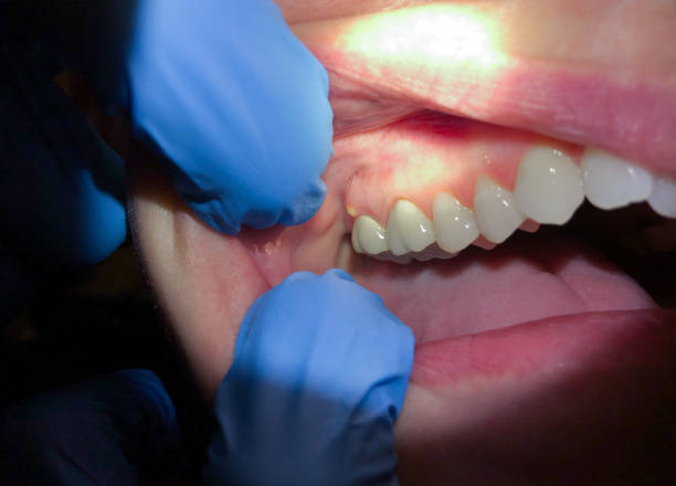 Best Emergency Dentist for Lost Fillings or Crowns in West Pelzer, SC
